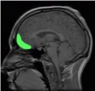 green-area-shows-the-orbitofrontal-cortex